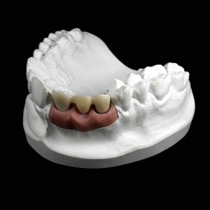 Prótesis dental sin metales: coronas, carillas e incrustaciones % %